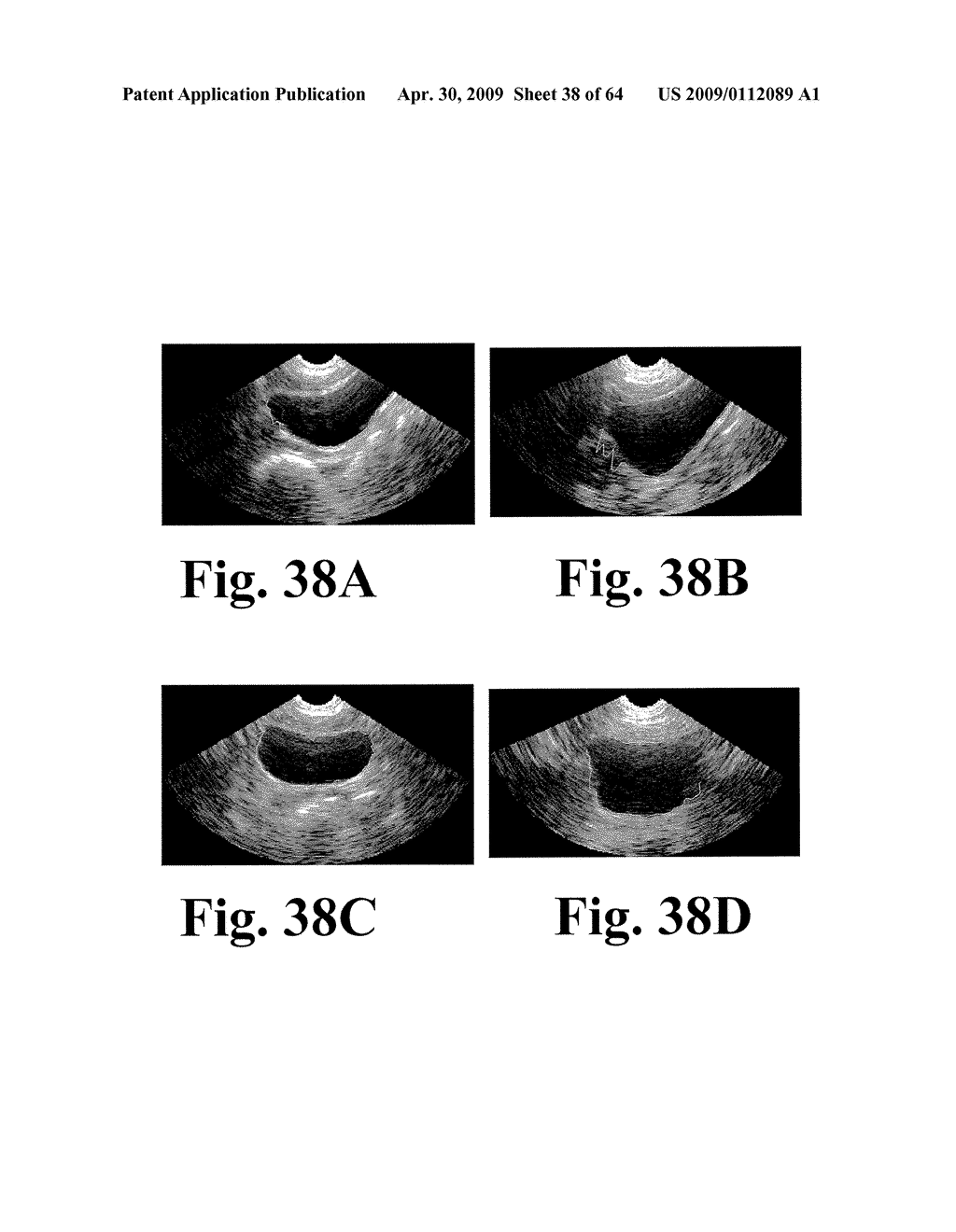 SYSTEM AND METHOD FOR MEASURING BLADDER WALL THICKNESS AND PRESENTING A BLADDER VIRTUAL IMAGE - diagram, schematic, and image 39