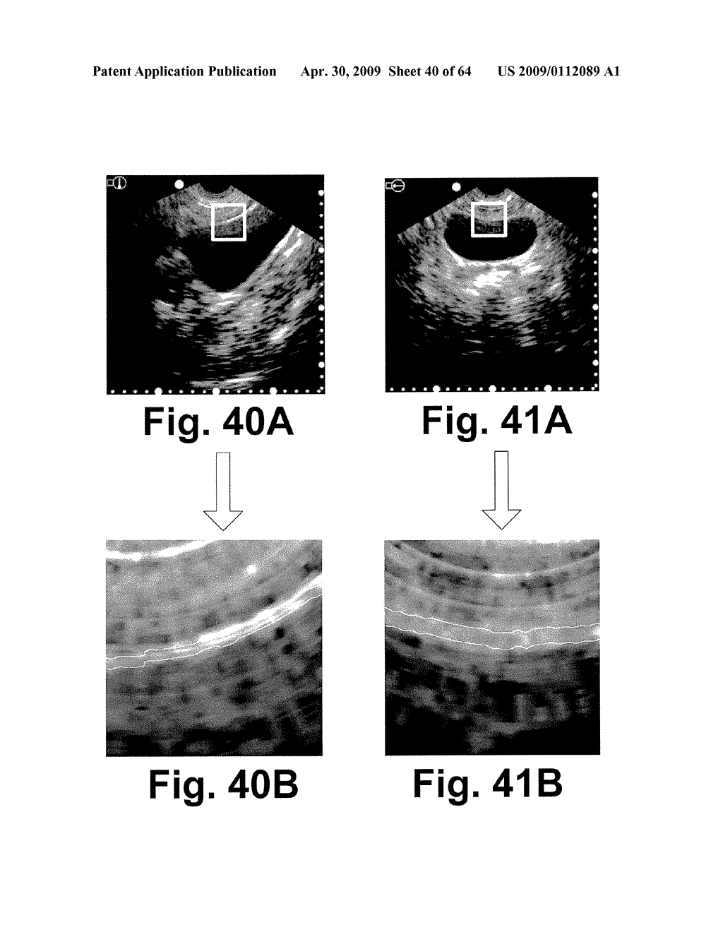 SYSTEM AND METHOD FOR MEASURING BLADDER WALL THICKNESS AND PRESENTING A BLADDER VIRTUAL IMAGE - diagram, schematic, and image 41