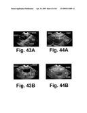 SYSTEM AND METHOD FOR MEASURING BLADDER WALL THICKNESS AND PRESENTING A BLADDER VIRTUAL IMAGE diagram and image