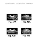 SYSTEM AND METHOD FOR MEASURING BLADDER WALL THICKNESS AND PRESENTING A BLADDER VIRTUAL IMAGE diagram and image