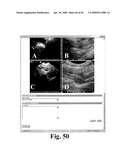 SYSTEM AND METHOD FOR MEASURING BLADDER WALL THICKNESS AND PRESENTING A BLADDER VIRTUAL IMAGE diagram and image