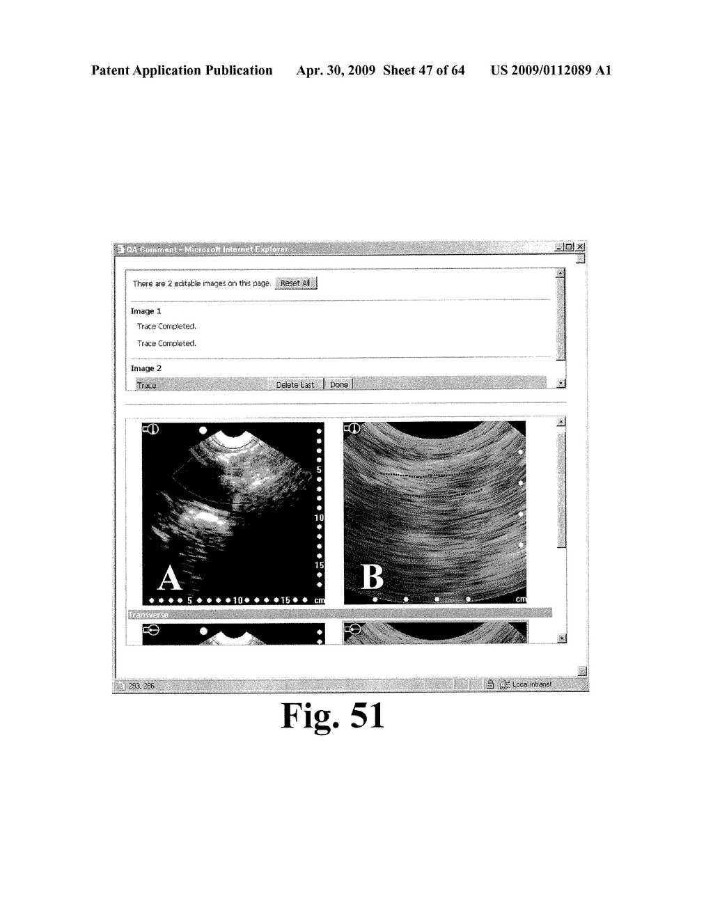 SYSTEM AND METHOD FOR MEASURING BLADDER WALL THICKNESS AND PRESENTING A BLADDER VIRTUAL IMAGE - diagram, schematic, and image 48