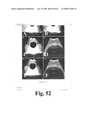 SYSTEM AND METHOD FOR MEASURING BLADDER WALL THICKNESS AND PRESENTING A BLADDER VIRTUAL IMAGE diagram and image