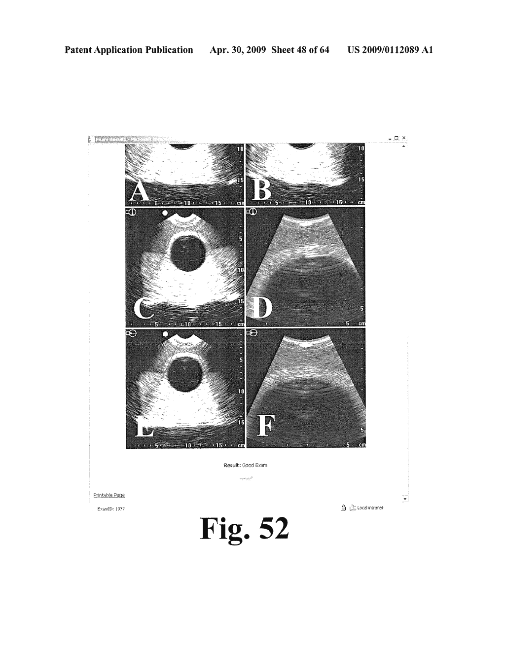 SYSTEM AND METHOD FOR MEASURING BLADDER WALL THICKNESS AND PRESENTING A BLADDER VIRTUAL IMAGE - diagram, schematic, and image 49