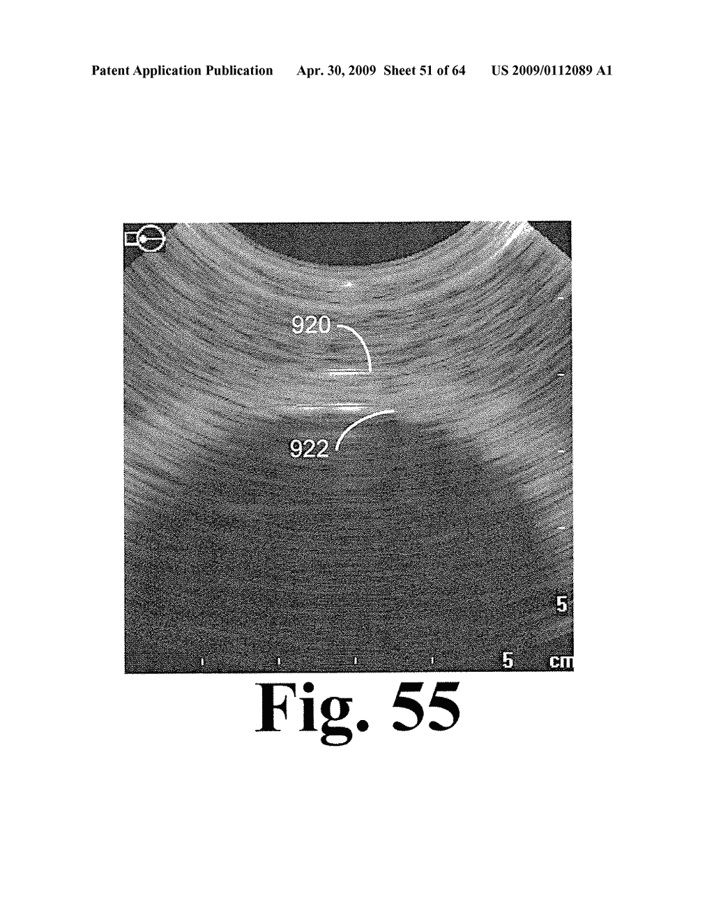 SYSTEM AND METHOD FOR MEASURING BLADDER WALL THICKNESS AND PRESENTING A BLADDER VIRTUAL IMAGE - diagram, schematic, and image 52