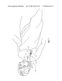 SPLIT-TIP CATHETER INCLUDING LATERAL DISTAL OPENINGS diagram and image