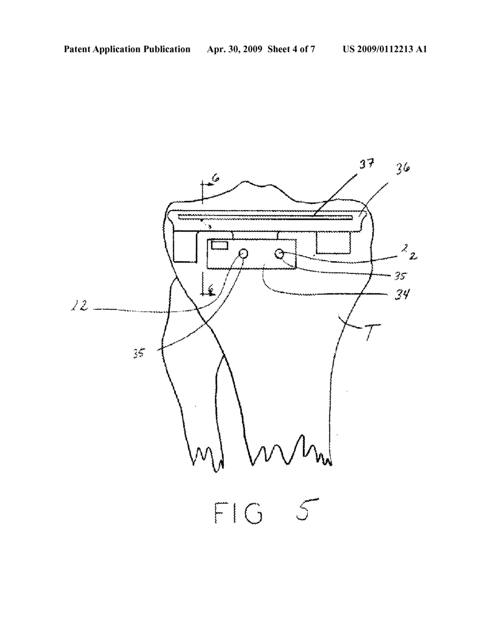 METHOD AND APPARATUS FOR REMOTE ALIGNMENT OF A CUT GUIDE - diagram, schematic, and image 05