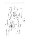 POLYP TOME diagram and image