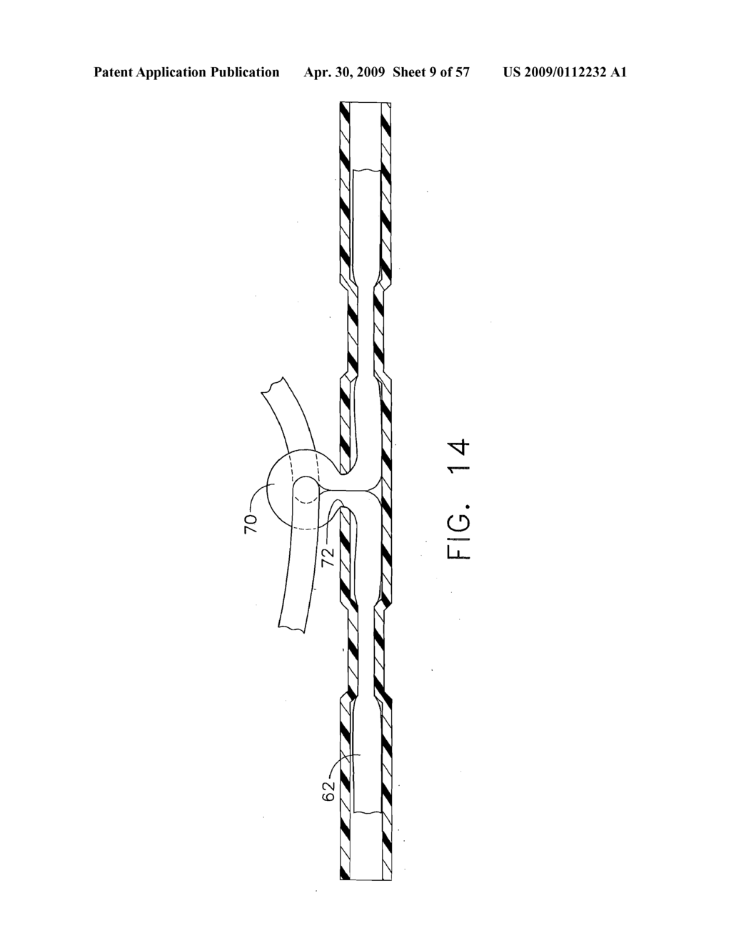 Method for Deploying A Device For Gastric Volume Reduction - diagram, schematic, and image 10