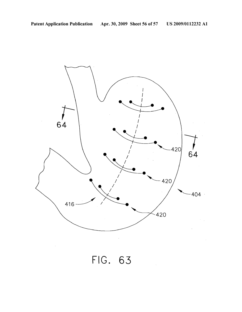 Method for Deploying A Device For Gastric Volume Reduction - diagram, schematic, and image 57