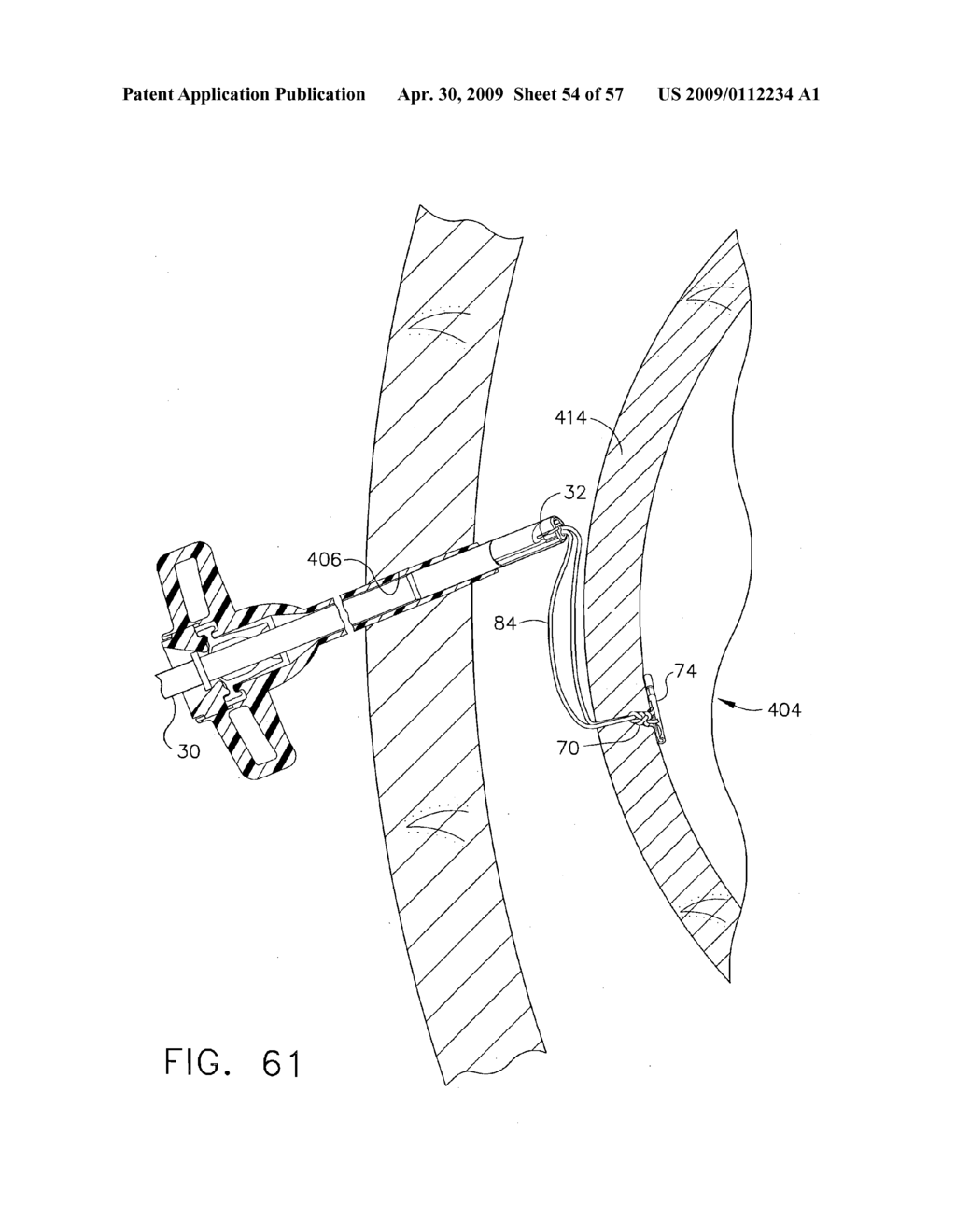 RELOADABLE LAPAROSCOPIC FASTENER DEPLOYING DEVICE FOR USE IN A GASTRIC VOLUME REDUCTION PROCEDURE - diagram, schematic, and image 55