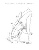 PIGMENTARY GLAUCOMA IRIS SCRAPING TREATMENT METHOD AND THE IRIS T ALUMINUM SCRAPING SCALPEL TOOL diagram and image