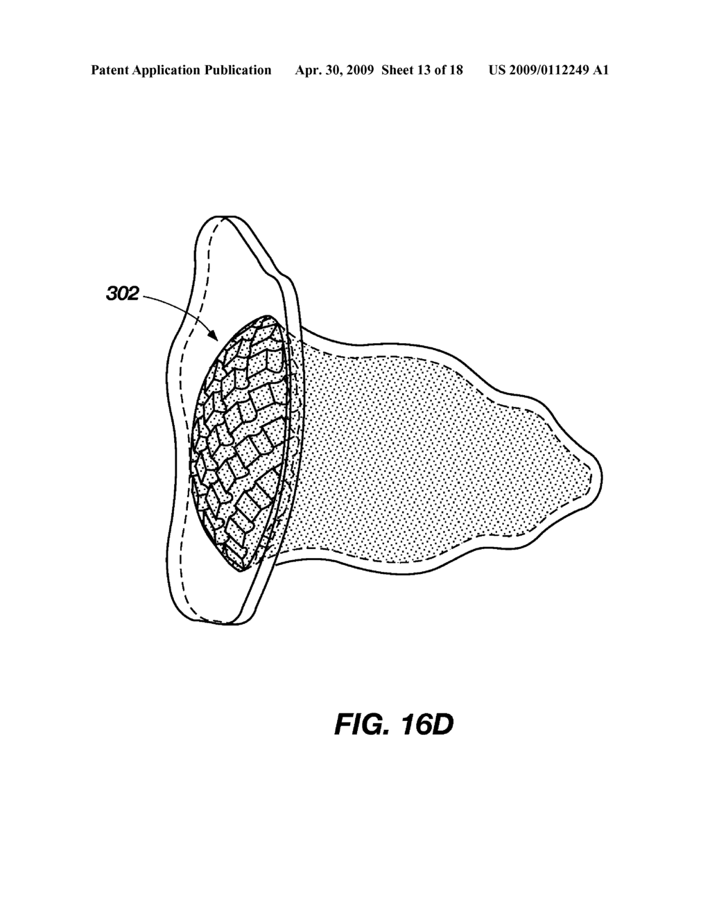 MEDICAL DEVICE FOR MODIFICATION OF LEFT ATRIAL APPENDAGE AND RELATED SYSTEMS AND METHODS - diagram, schematic, and image 14