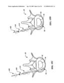 DEVICES AND METHODS FOR THE TREATMENT OF SPINAL DISORDERS diagram and image