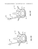 DEVICES AND METHODS FOR THE TREATMENT OF SPINAL DISORDERS diagram and image