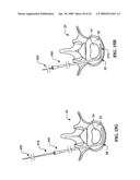 DEVICES AND METHODS FOR THE TREATMENT OF SPINAL DISORDERS diagram and image