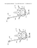 DEVICES AND METHODS FOR THE TREATMENT OF SPINAL DISORDERS diagram and image