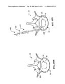 DEVICES AND METHODS FOR THE TREATMENT OF SPINAL DISORDERS diagram and image