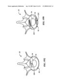 DEVICES AND METHODS FOR THE TREATMENT OF SPINAL DISORDERS diagram and image