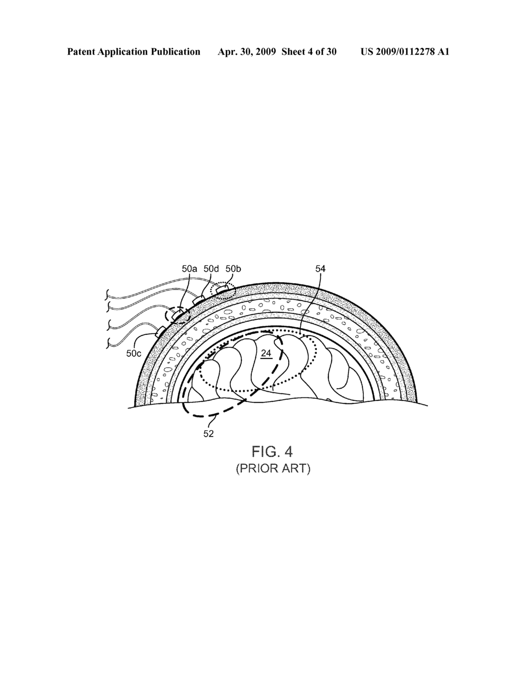 Systems, Methods and Devices for a Skull/Brain Interface - diagram, schematic, and image 05