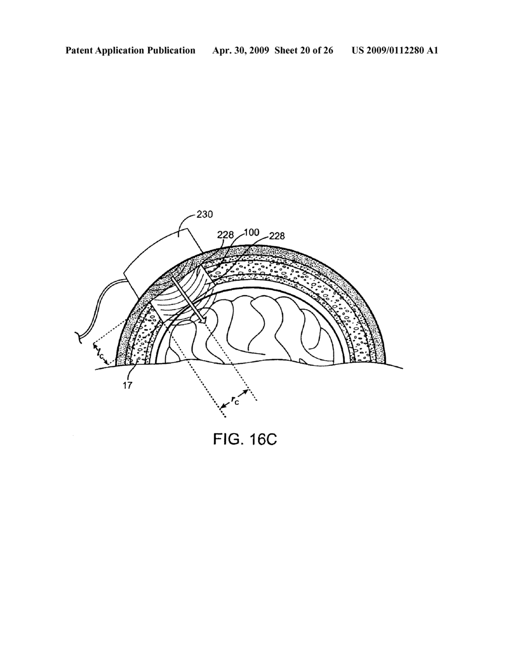 SYSTEMS, METHODS AND DEVICES FOR A SKULL/BRAIN INTERFACE - diagram, schematic, and image 21