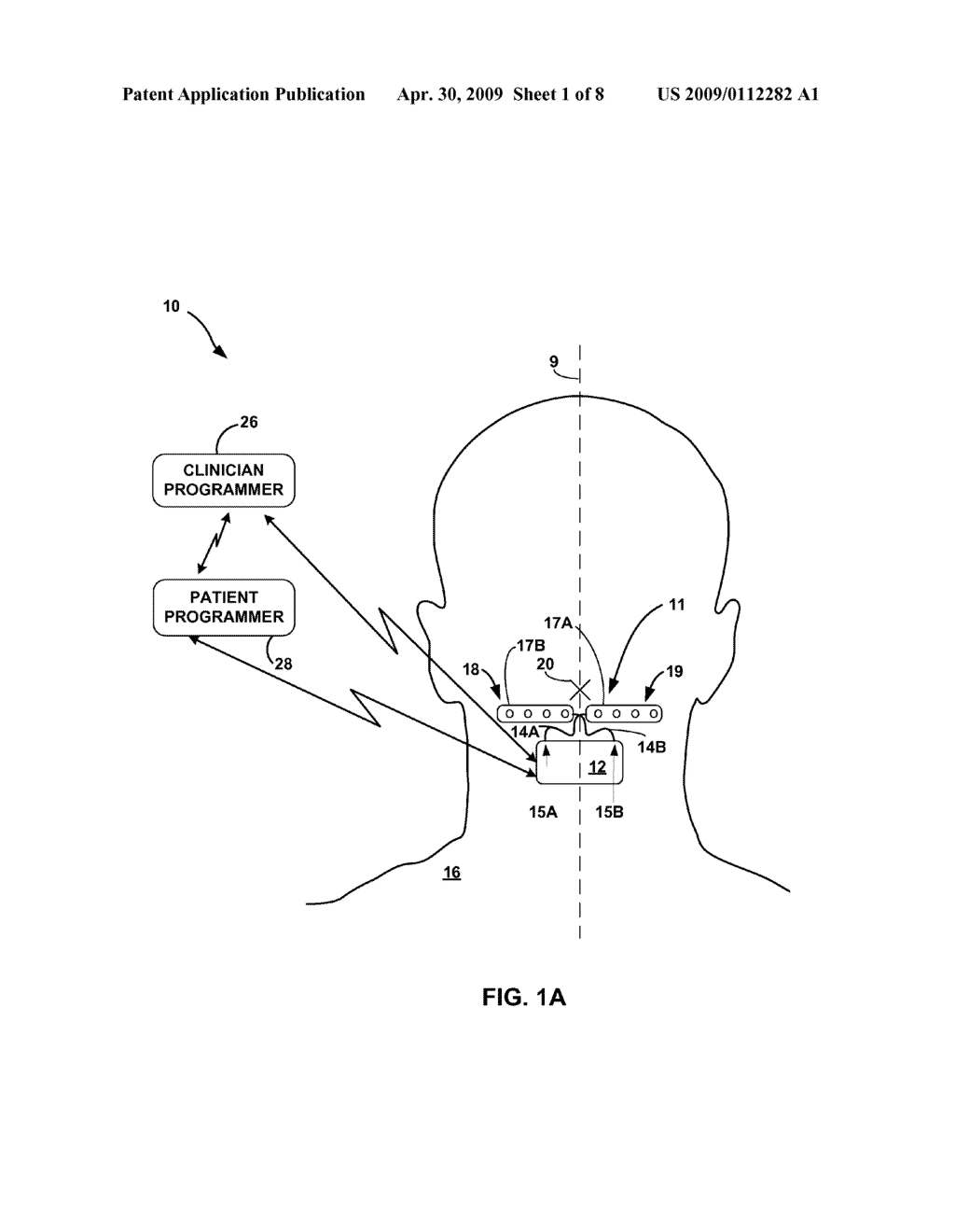 OCCIPITAL NERVE STIMULATION - diagram, schematic, and image 02