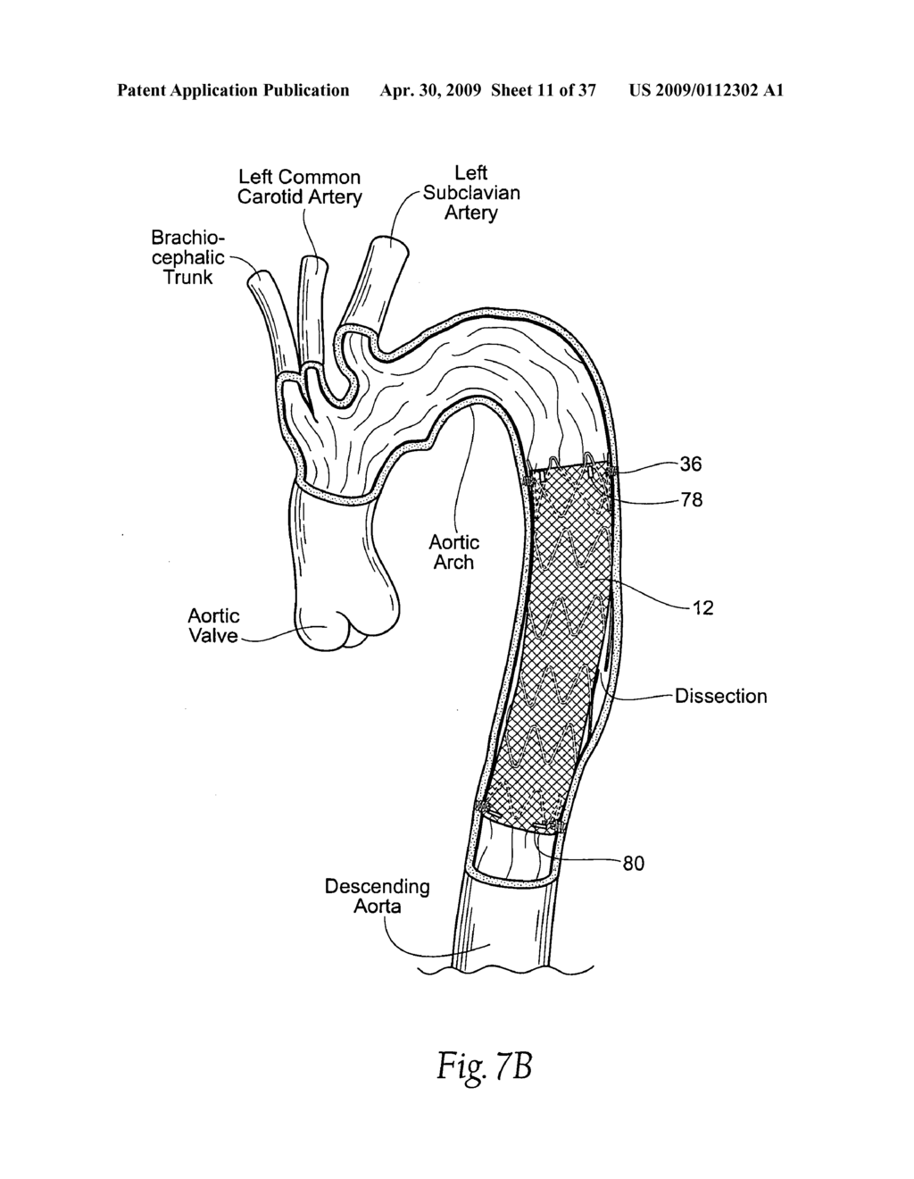 Devices, systems, and methods for endovascular staple and/or prosthesis delivery and implantation - diagram, schematic, and image 12