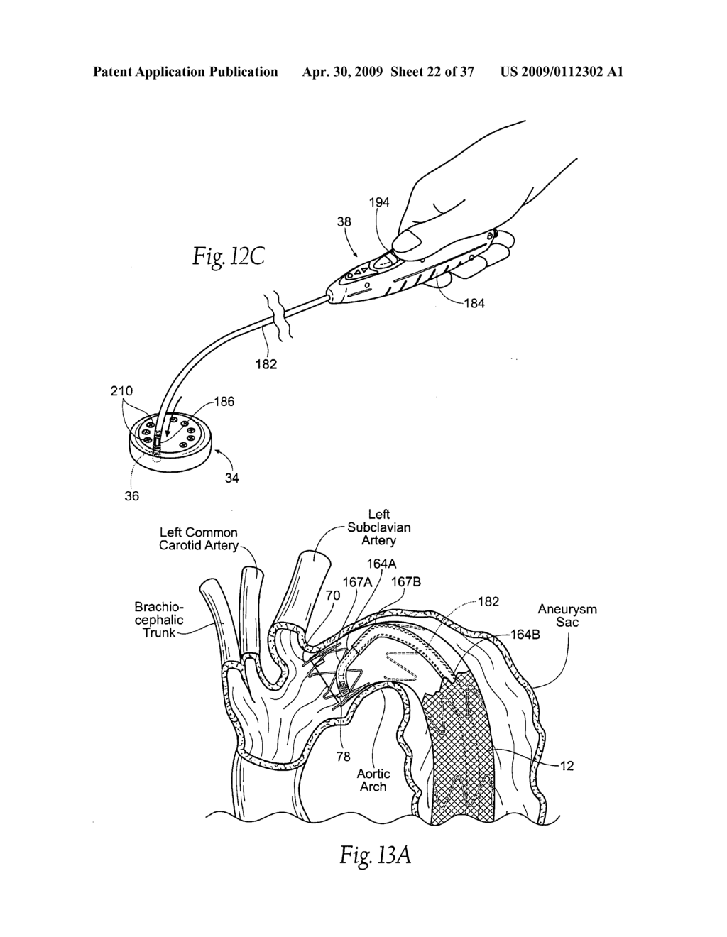 Devices, systems, and methods for endovascular staple and/or prosthesis delivery and implantation - diagram, schematic, and image 23