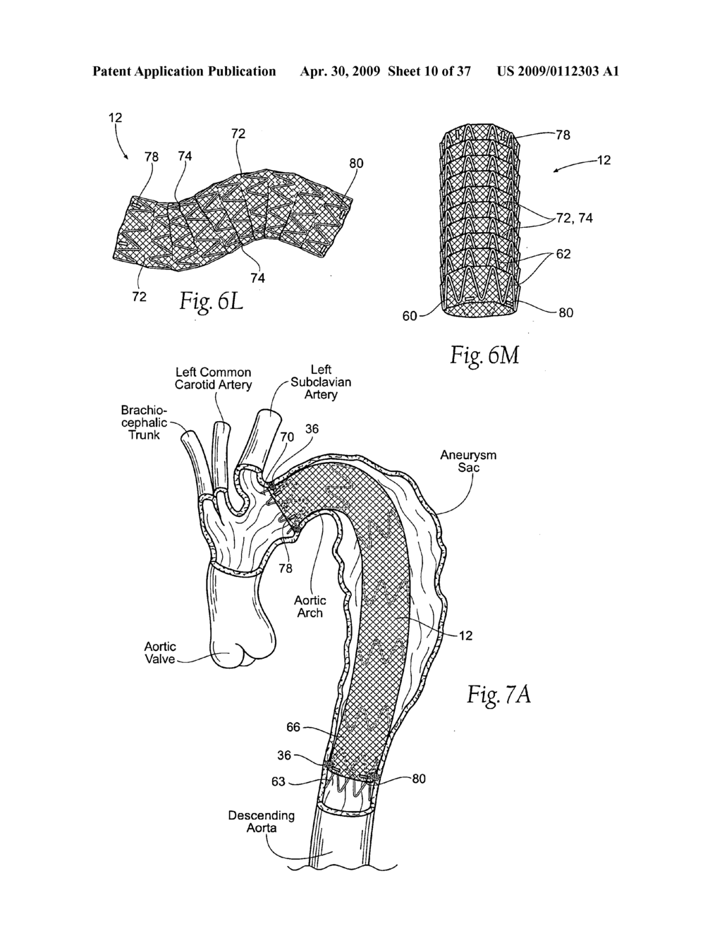 Devices, systems, and methods for endovascular staple and/or prosthesis delivery and implantation - diagram, schematic, and image 11