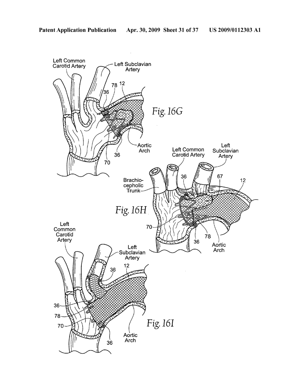 Devices, systems, and methods for endovascular staple and/or prosthesis delivery and implantation - diagram, schematic, and image 32