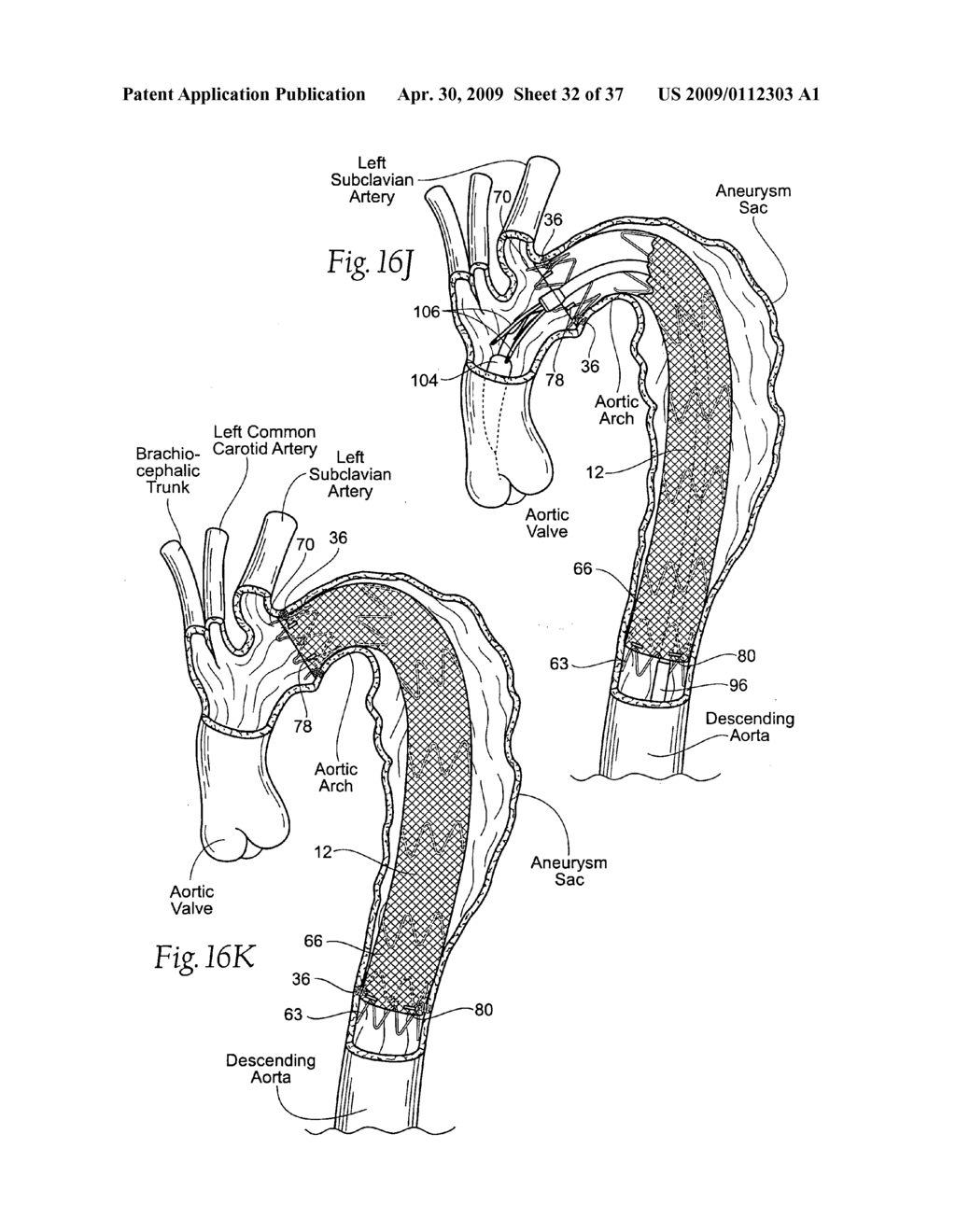 Devices, systems, and methods for endovascular staple and/or prosthesis delivery and implantation - diagram, schematic, and image 33