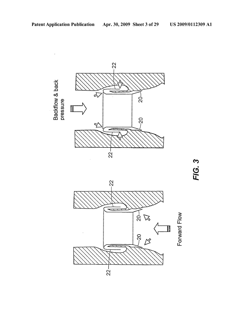 Collapsible Heart Valve with Polymer Leaflets - diagram, schematic, and image 04