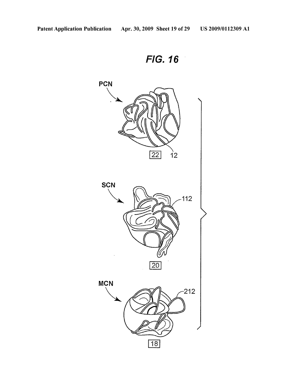 Collapsible Heart Valve with Polymer Leaflets - diagram, schematic, and image 20