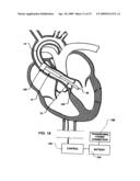 Intravascular ventricular assist device diagram and image