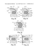 IN SITU ADJUSTABLE DYNAMIC INTERVERTEBRAL IMPLANT diagram and image