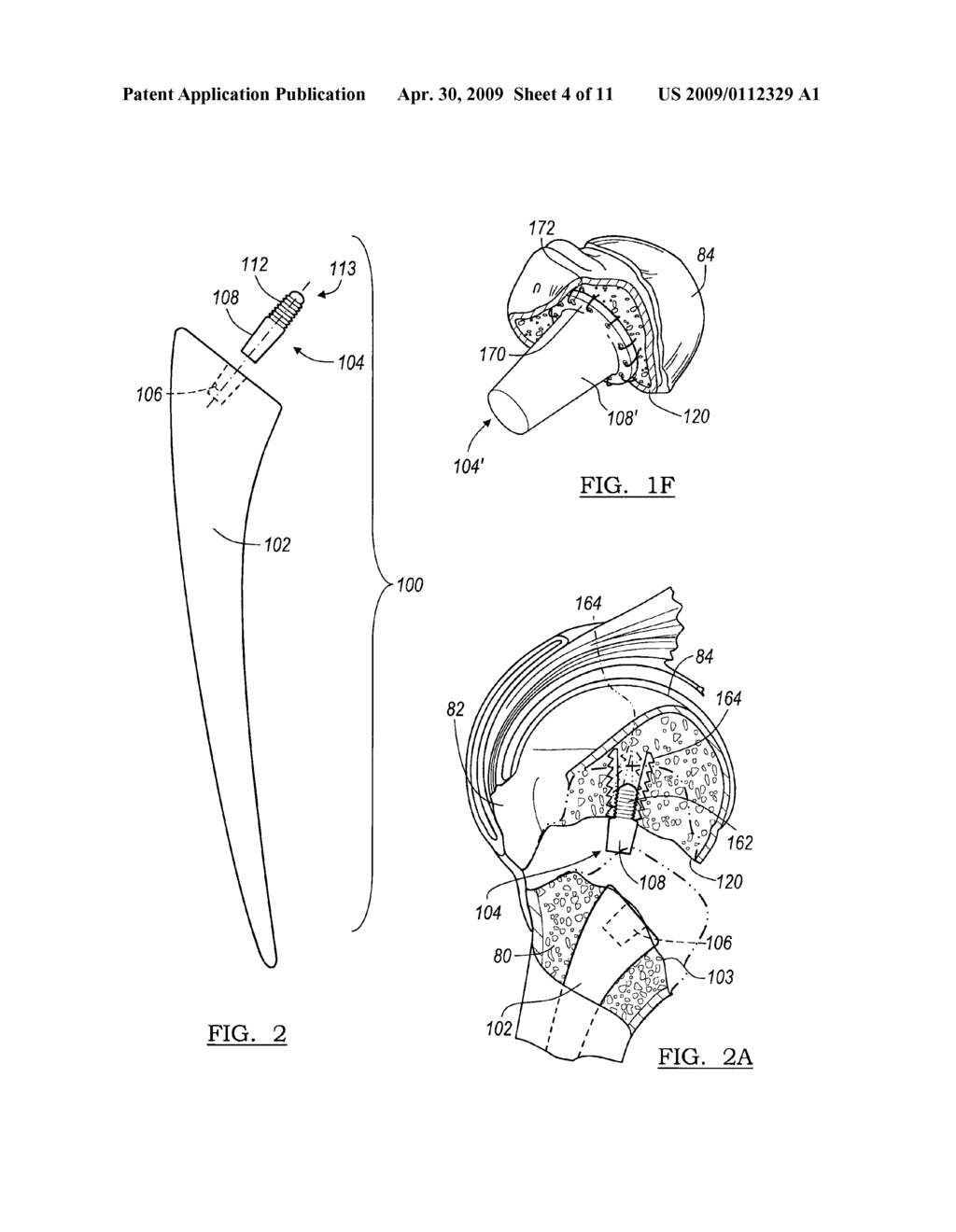 Humeral Head Preserving Implant - diagram, schematic, and image 05