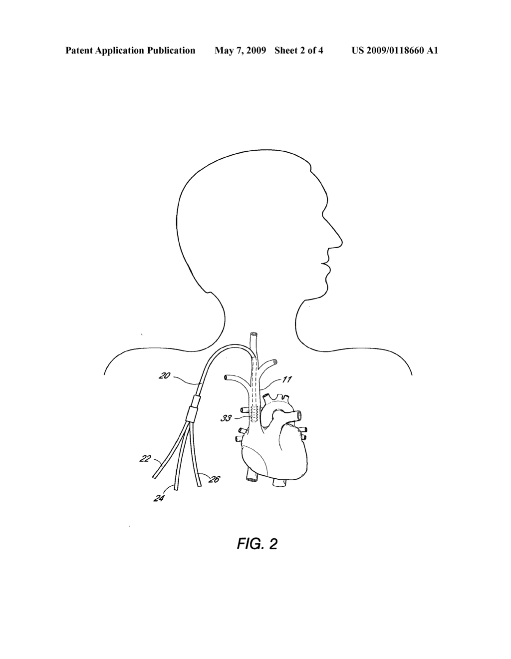 APPARATUS AND METHOD FOR IN-VIVO PLASMAPHERESIS USING PERIODIC BACKLUSH CONTAINING ANTICOAGULANT - diagram, schematic, and image 03