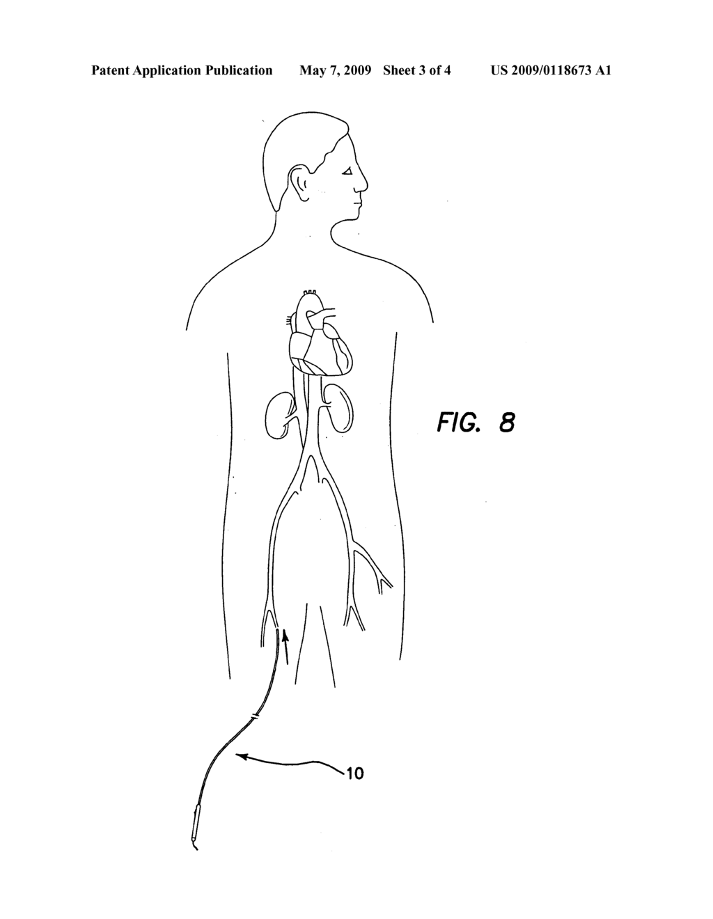 NEEDLE INJECTION CATHETER - diagram, schematic, and image 04