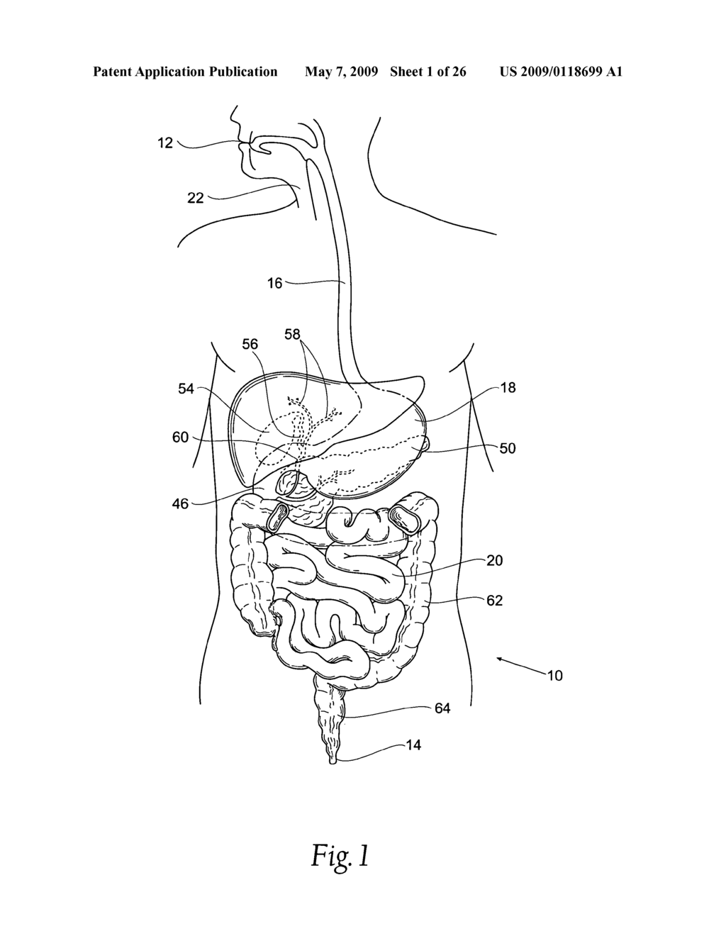 Systems and methods for treating obesity and other gastrointestinal conditions - diagram, schematic, and image 02