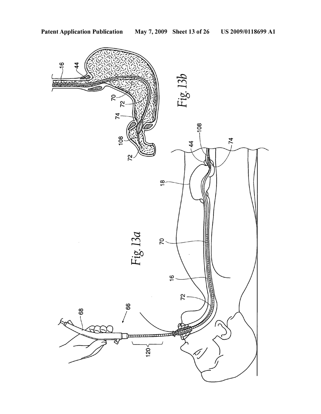 Systems and methods for treating obesity and other gastrointestinal conditions - diagram, schematic, and image 14