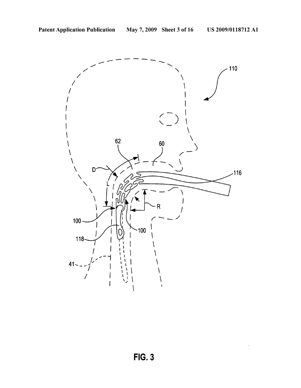 Flexible transoral endoscopic gastroesophageal flap valve restoration device and method - diagram, schematic, and image 04