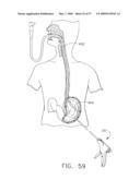 Disposable cartridge for use in a gastric volume reduction procedure diagram and image