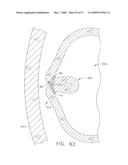 Disposable cartridge for use in a gastric volume reduction procedure diagram and image