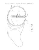 Disposable cartridge for use in a gastric volume reduction procedure diagram and image