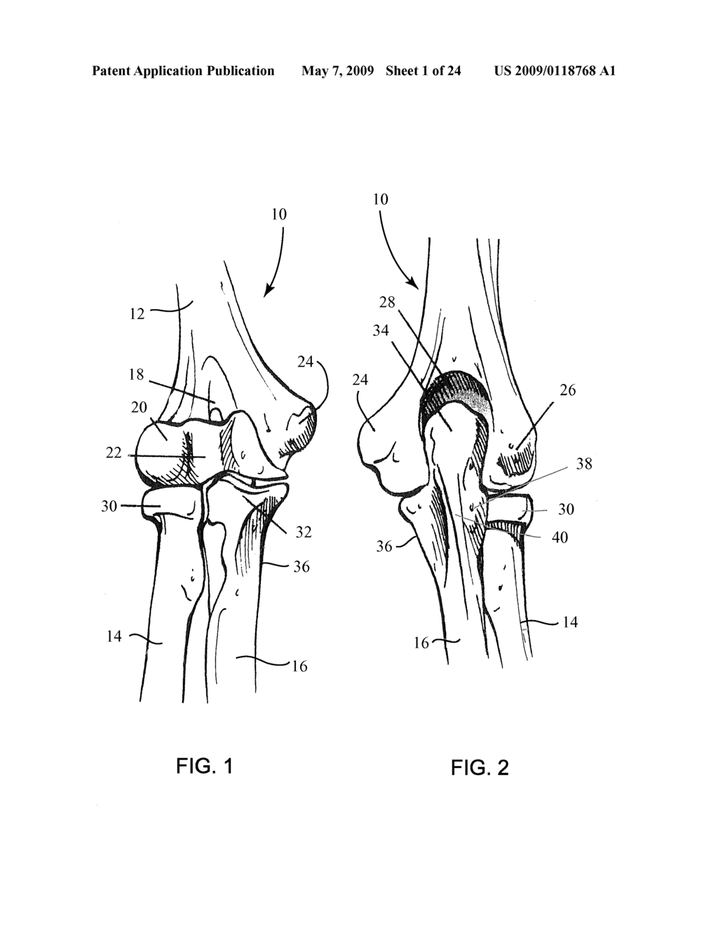 Elbow Fracture Fixation System - diagram, schematic, and image 02