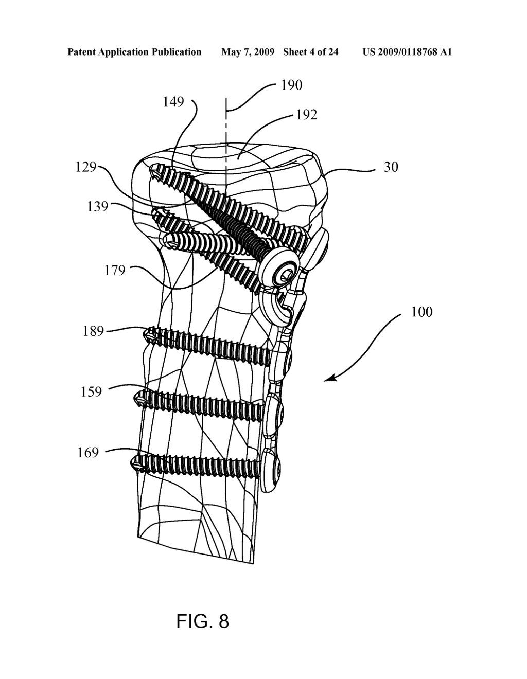 Elbow Fracture Fixation System - diagram, schematic, and image 05