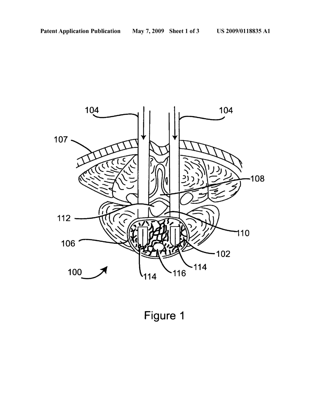 Prosthetic Intervertebral Discs Having Rotatable, Expandable Cores That Are Implantable Using Minimally Invasive Surgical Techniques - diagram, schematic, and image 02