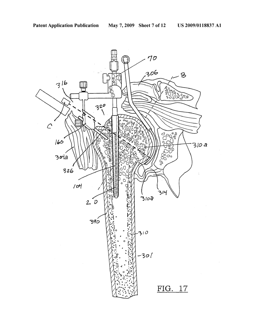 Method and Apparatus for Performing a Less Invasive Shoulder Procedure - diagram, schematic, and image 08