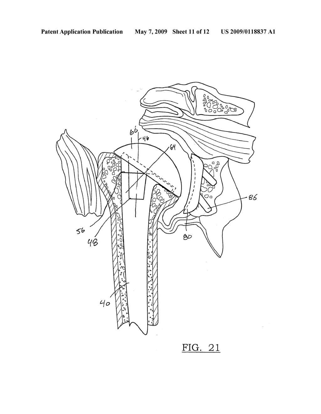 Method and Apparatus for Performing a Less Invasive Shoulder Procedure - diagram, schematic, and image 12