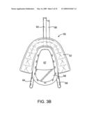 METHODS AND SYSTEMS FOR CREATING PRESSURE GRADIENTS TO IMPROVE AIRWAY PATENCY diagram and image